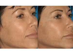 How Microneedling Minimizes Lines and Wrinkles