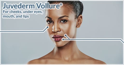 Juvederm Vollure<sup>®</sup> $595