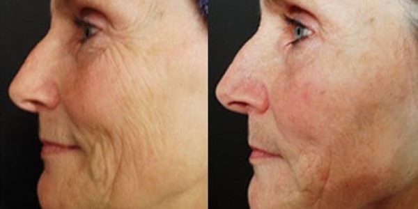pronounced-results-ageless-center-microneedling